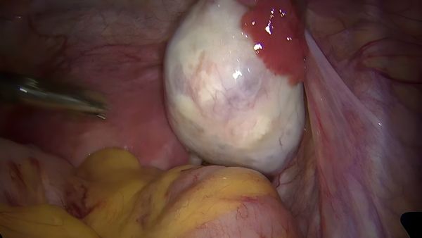 CA MỔ CHO BỆNH NHÂN BỊ NANG BUỒNG TRỨNG
