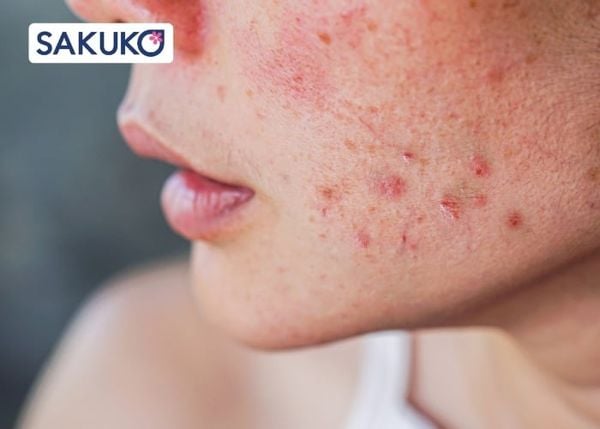 Da đang bị mụn có nên dùng kem chống nắng không?