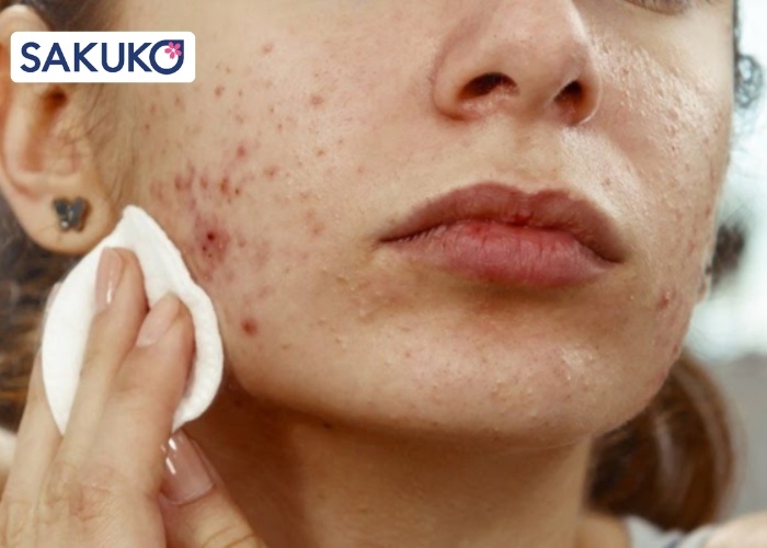 Tác động của nước tẩy trang đến làn da mụn