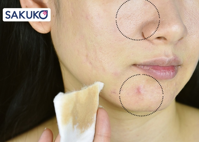 Lưu ý khi thực hiện tẩy trang cho làn da mụn