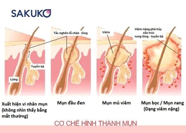 Nguyên nhân hình thành mụn