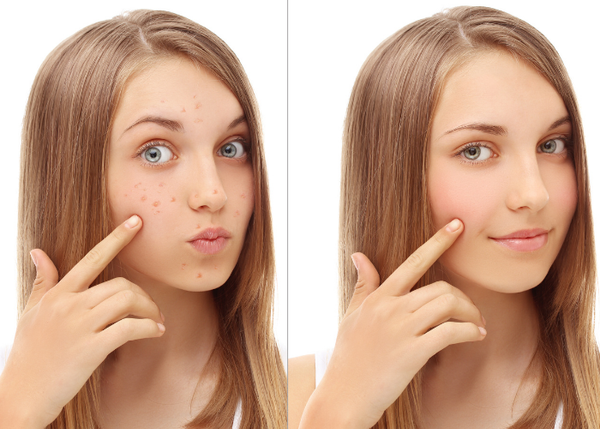 Làm sạch da và ngăn ngừa các vấn đề về mụn