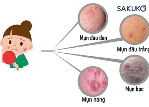 Làn da ở độ tuổi dậy thì thường gặp các tình trạng về mụn