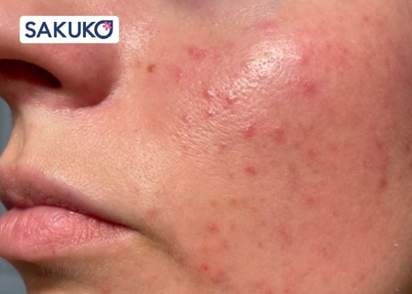 Tình trạng da dầu mụn để lựa chọn kem chống nắng phù hợp