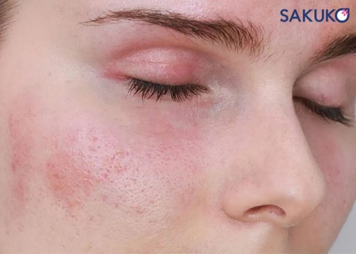 Nguyên nhân khiến da mặt khô sần ngứa