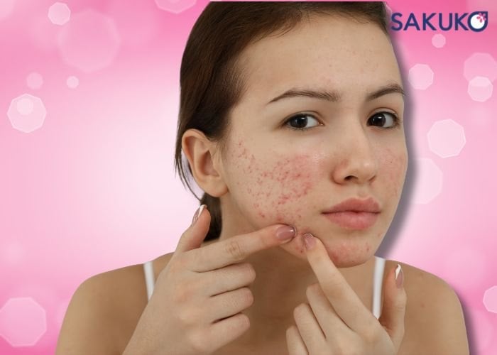 Phân loại da mụn phổ biến hiện nay