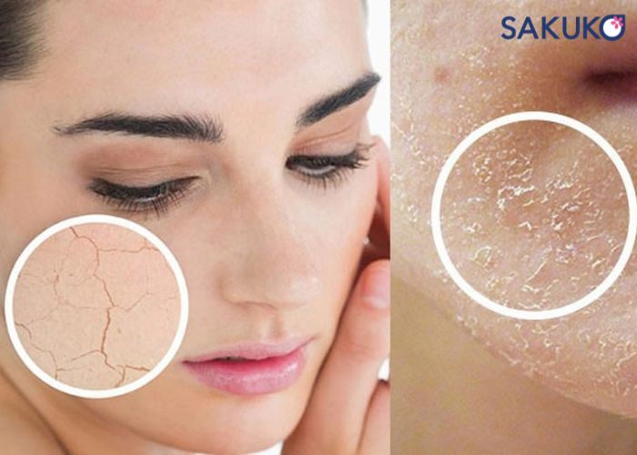Da mặt bị khô là gì? Dấu hiệu nhận biết