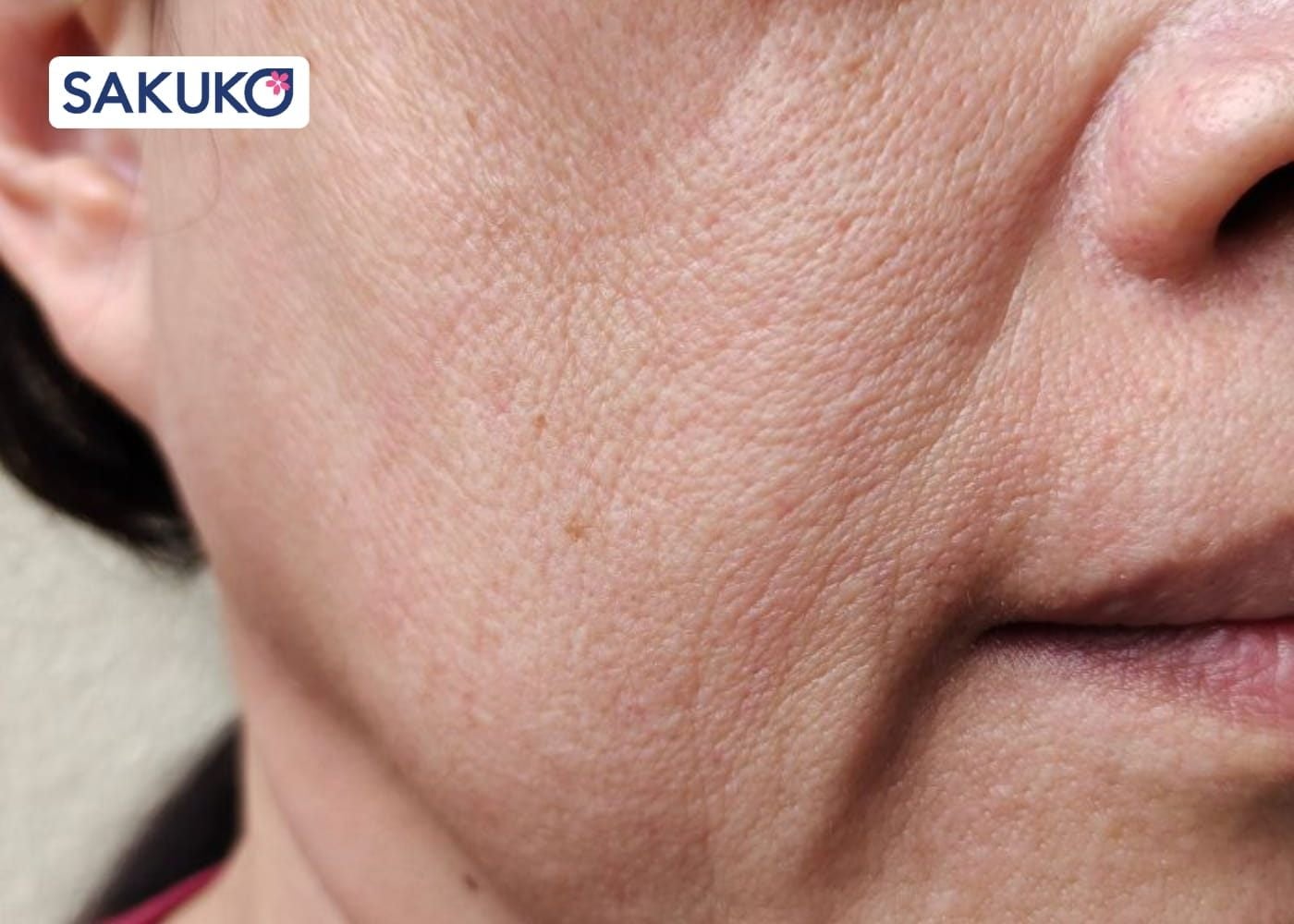 Nguyên nhân khiến mặt kém thon gọn,&nbsp;chảy xệ