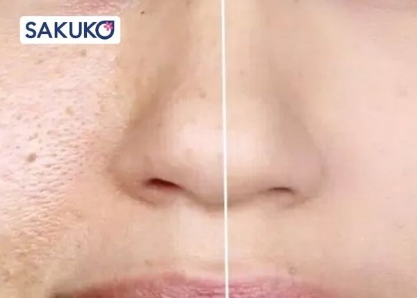 Sự khác nhau khi bạn dùng toner và không dùng toner cho làn da