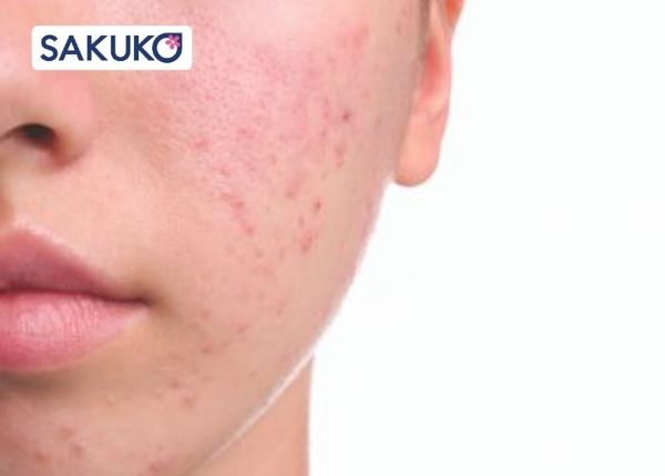 Các yếu tố làm tăng sắc tố da