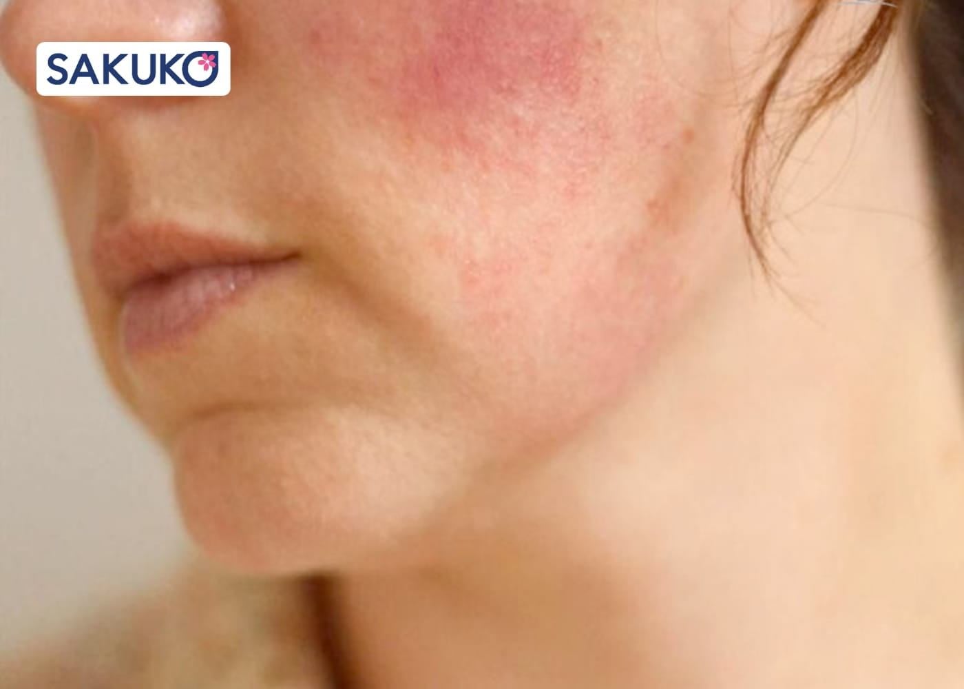 Tác hại của nâng cơ HIFU biến chứng nguy hiểm