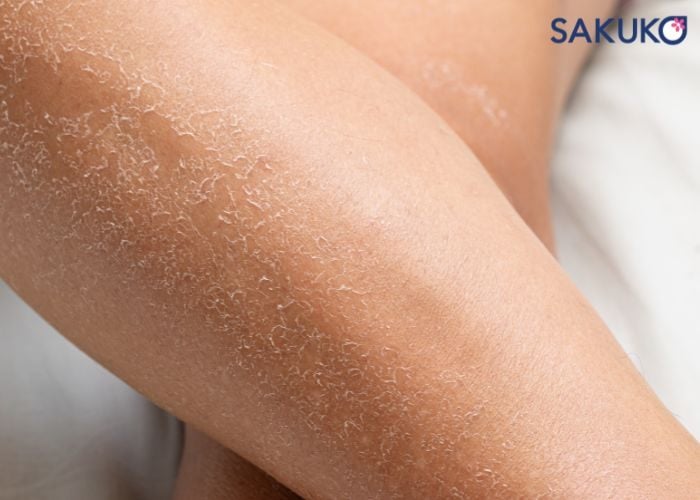 Tại sao da khô cần kem dưỡng ẩm body chuyên biệt?