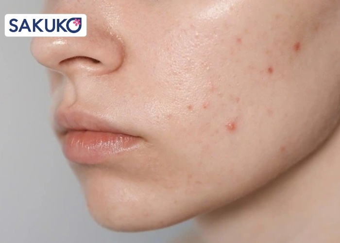 Hiểu về làn da dầu mụn để chăm sóc đúng cách