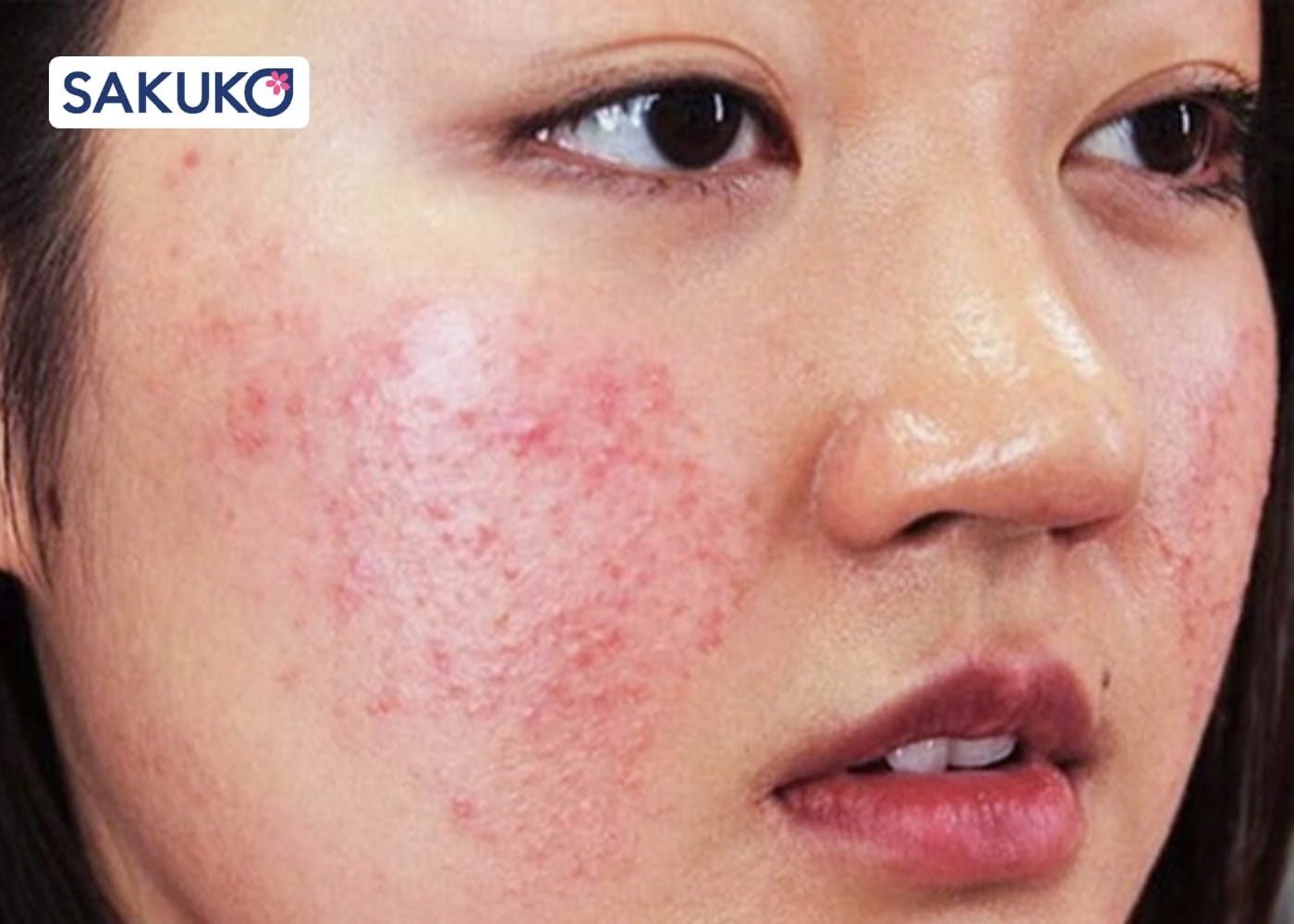 Da bị kích ứng bao lâu thì hết?