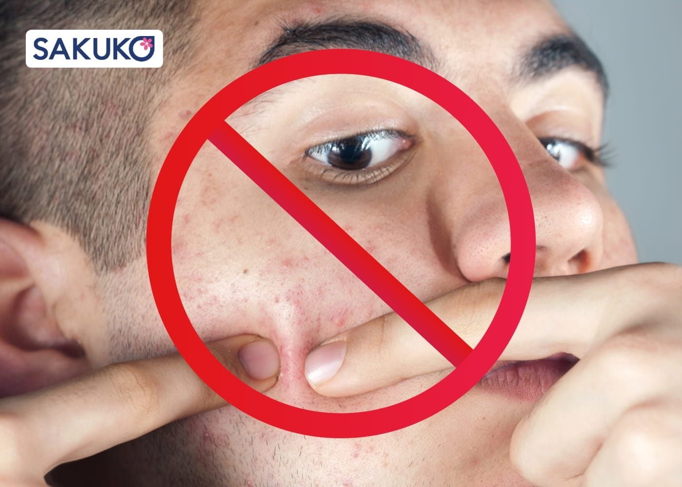 Những nguyên tắc&nbsp;khi skincare cho da mụn ẩn không tự ý nặn mụn