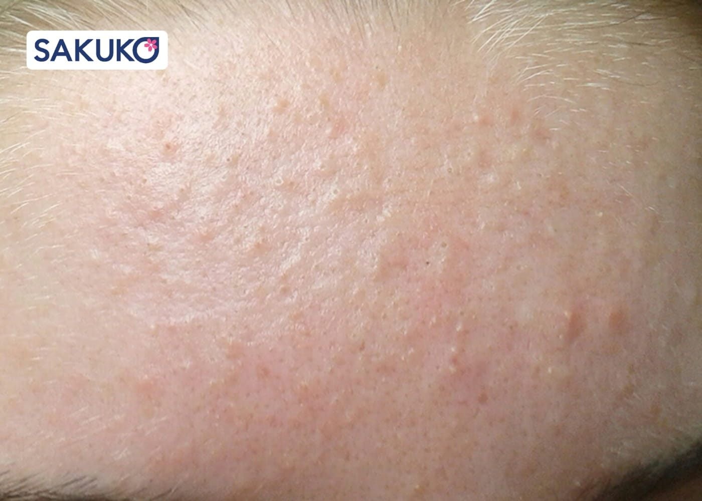 Mụn ẩn là gì và tại sao lại xuất hiện?