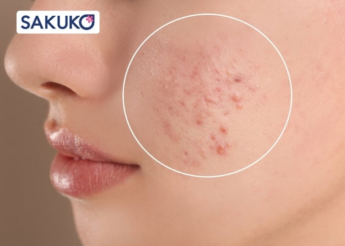 Nguyên tắc khi thực hiện skincare cho da mụn ẩn