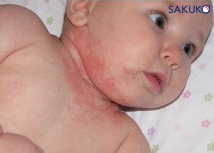 Tình trạng dị ứng đạm sữa bò ở trẻ nhỏ là gì?