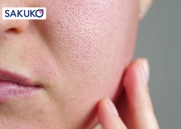 Bản chất của lỗ chân lông và cơ chế gây ra tình trạng 