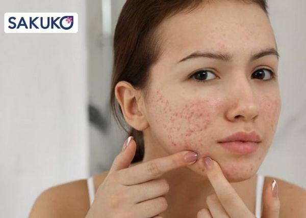 Cách xử lý tình trạng khi dùng serum bị lên mụn
