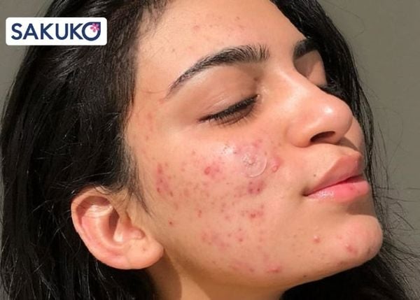 Hiện tượng đẩy mụn, kích ứng và bùng phát mụn trên da