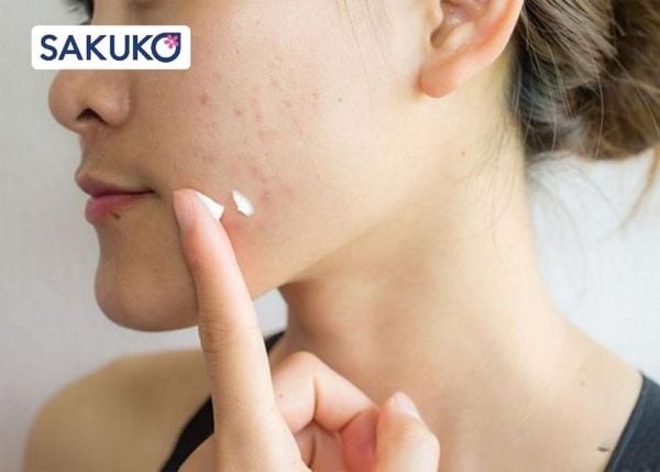 Tiêu chí lựa chọn kem chống nắng phù hợp dành cho da dầu mụn