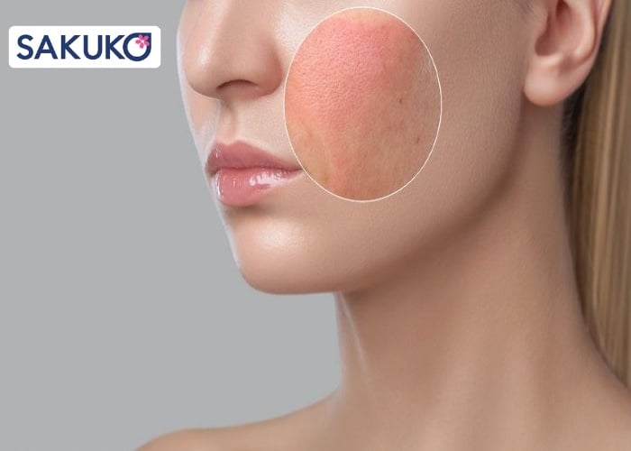 Sữa rửa mặt hết hạn có dùng được không?