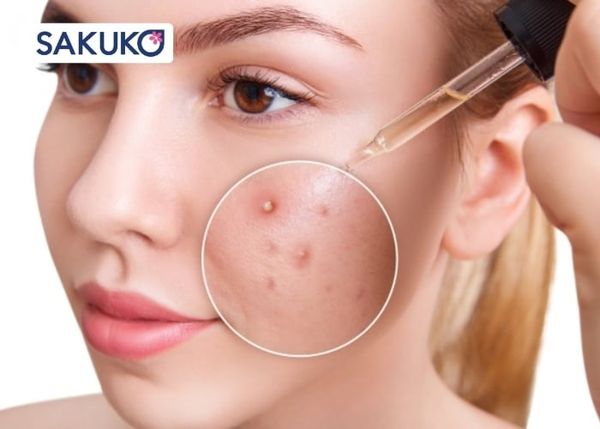 Tại sao bôi sai thứ tự toner và serum lại gây mụn?