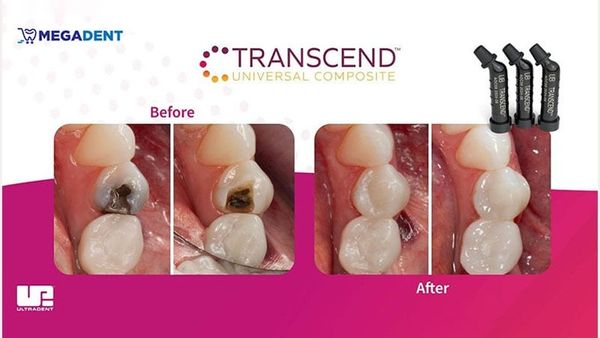 Composite đặc  - Transcend Universal Body