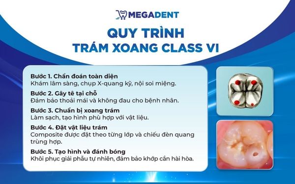 Quy trình trám Class VI theo tiêu chuẩn lâm sàng