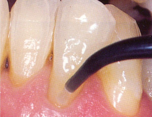Điều trị nhạy cảm cổ răng Dentin Sealant