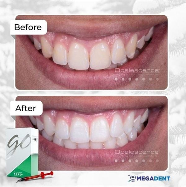 Giải pháp xử lý đốm trắng & tẩy trắng răng an toàn cùng Ultradent