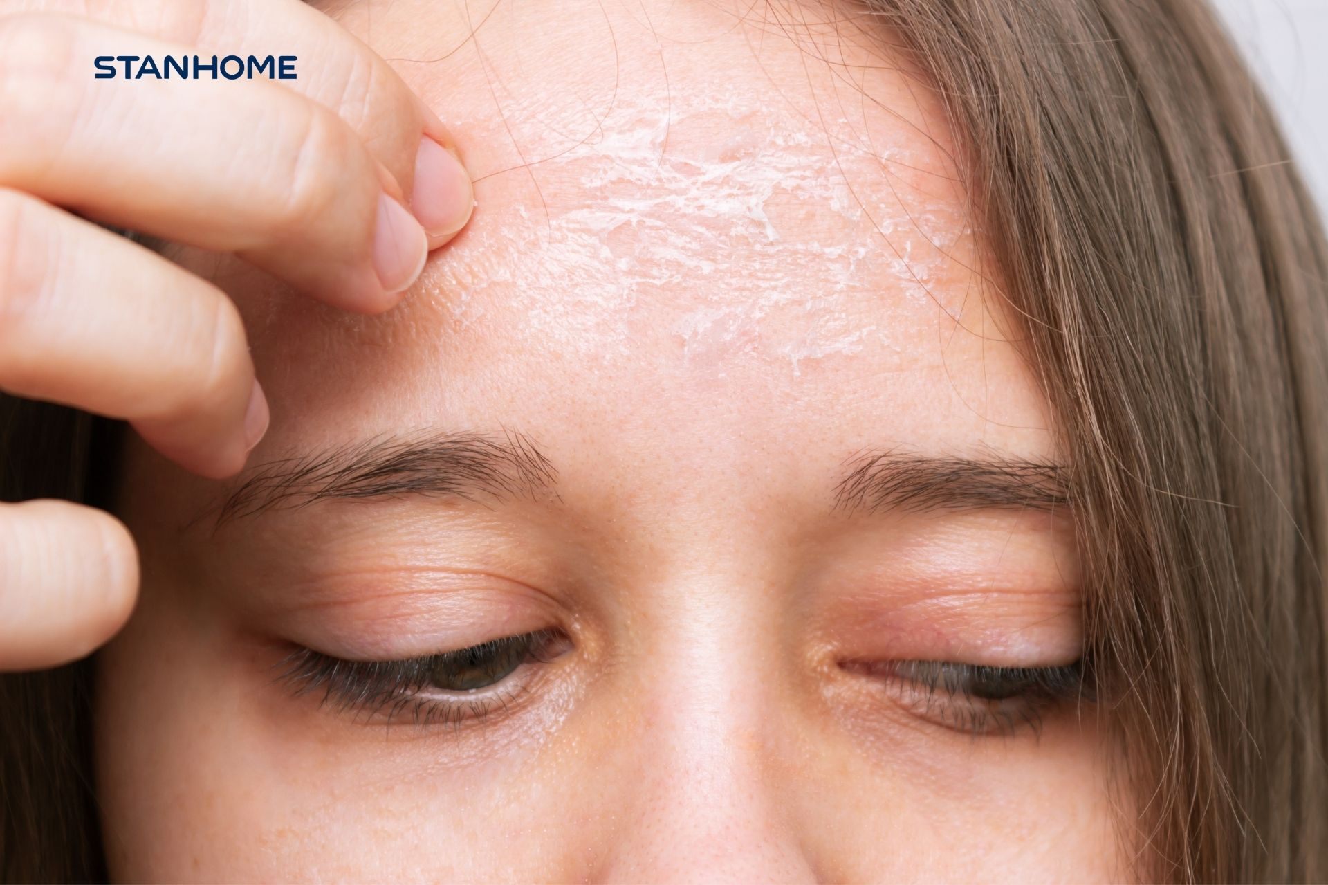 Da khô sần sùi, bong tróc từng mảng mùa hanh khô