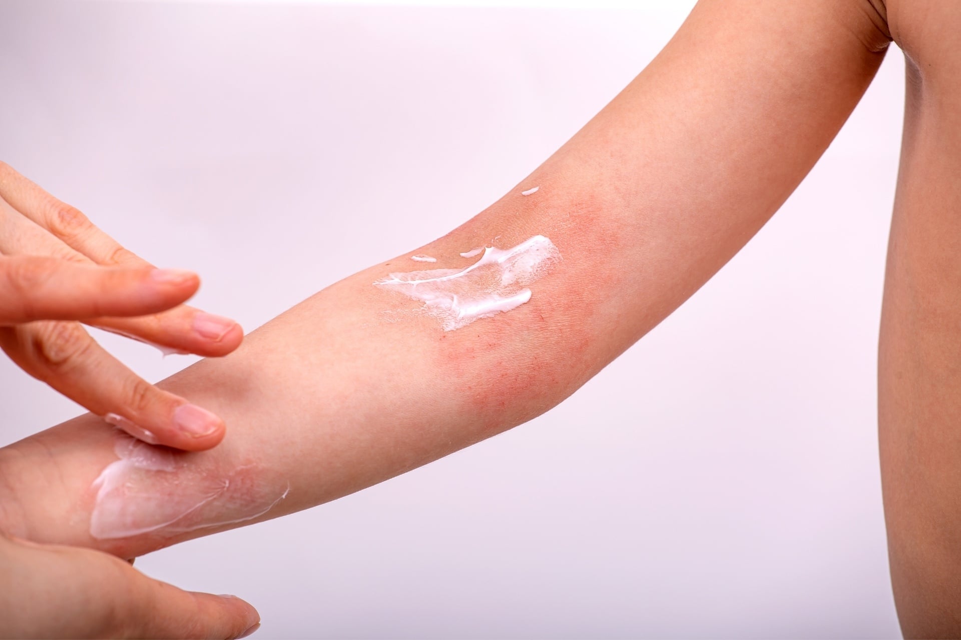 Sử dụng kem dưỡng ẩm phục hồi, giảm khô, giảm ngứa hàng ngày để phòng ngừa ngứa da toàn thân