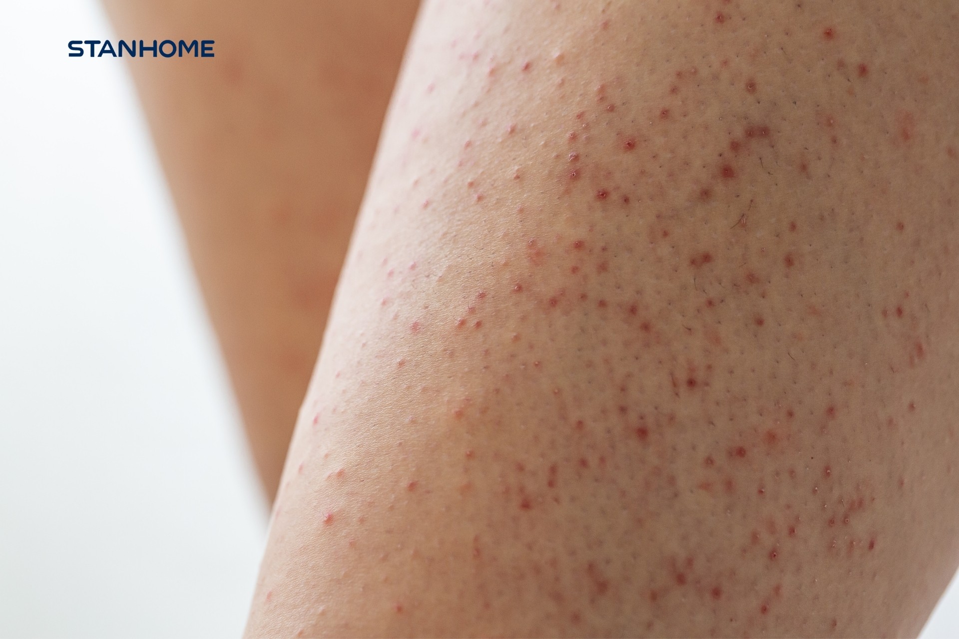 Viêm nang lông gây mất thẩm mỹ khiến người bệnh tự ti khi lựa chọn trang phục