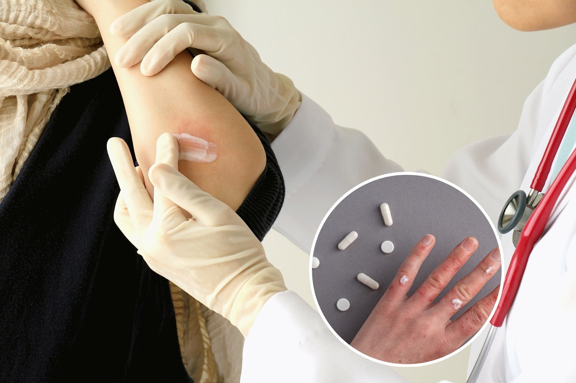 Sử dụng thuốc bôi viêm da cơ địa, thuốc uống kháng histamin để giảm tình trạng ngứa do bệnh lý da như viêm da cơ địa