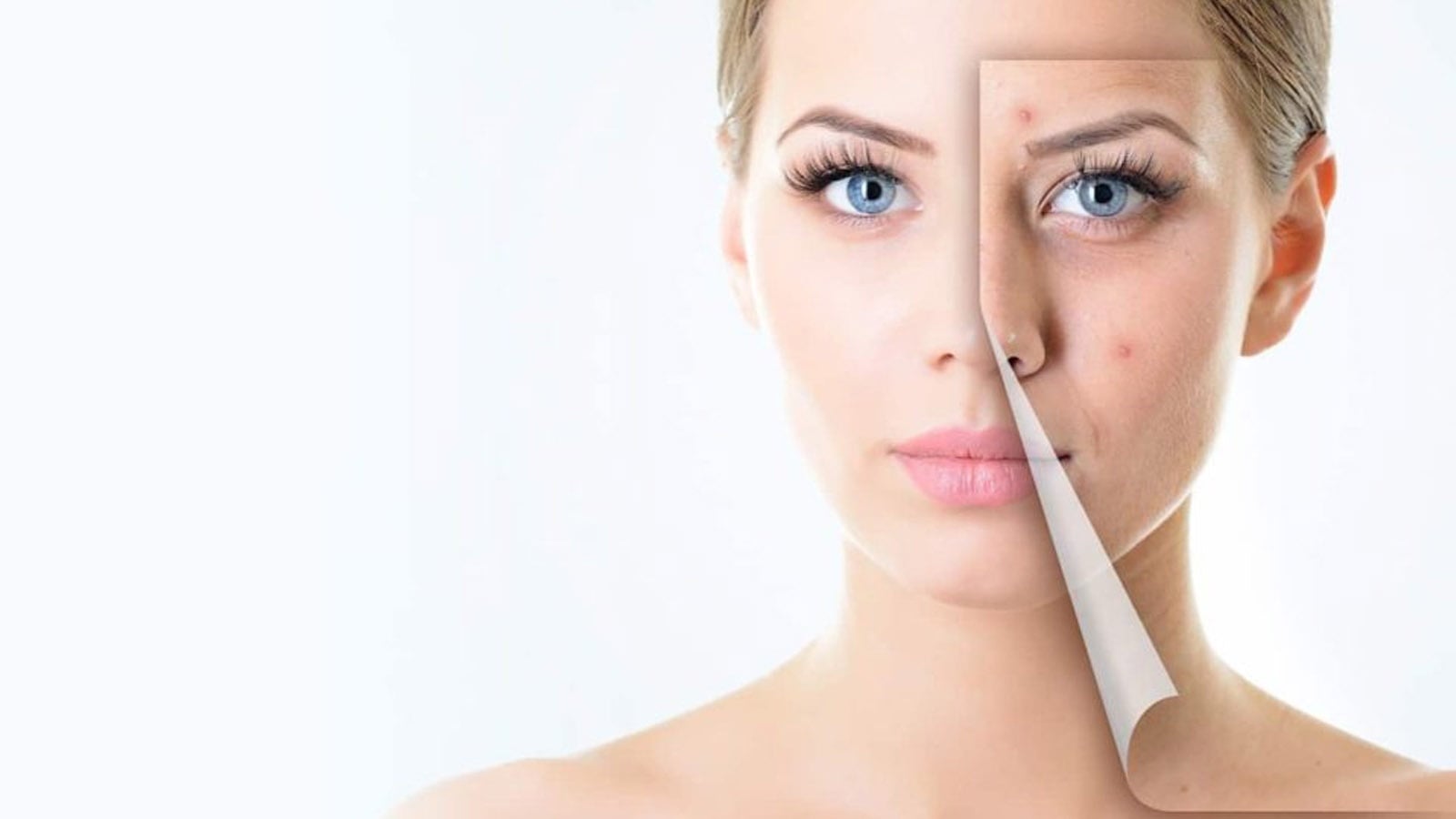 Mụn tái phát liên tục và cách xử lý tại ThanhSkin Spa