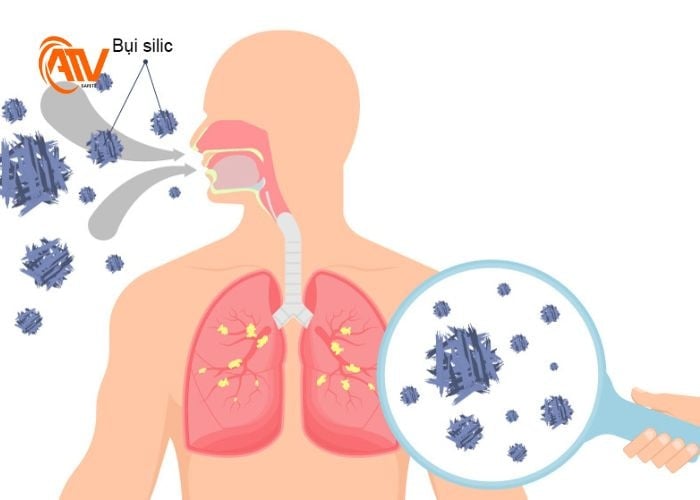 Quá trình hình thành bệnh bụi phổi nghề nghiệp