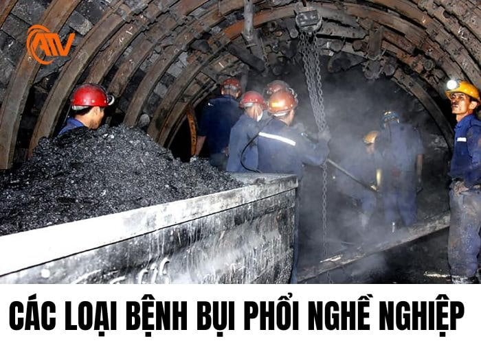 Các loại bệnh bụi phổi nghề nghiệp phổ biến