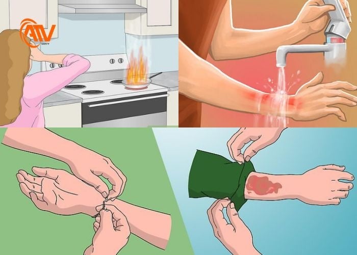 Bị bỏng dầu thì nên làm gì