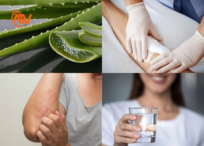 Cách chăm sóc vết bỏng dầu tại nhà