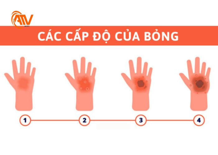 Các cấp độ bỏng nên biết