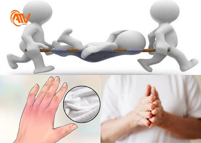 Sơ cứu bỏng lạnh ở những bước đầu