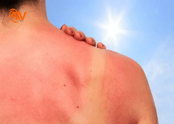 Nguy cơ bỏng da gây nguy hiểm cho làn da