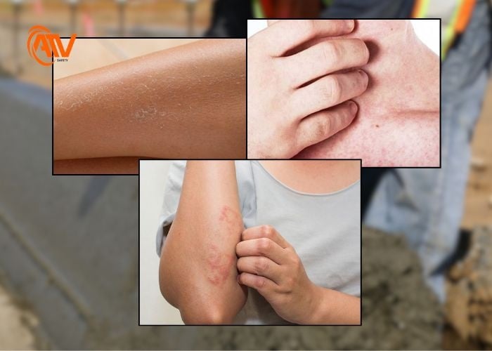 Các dấu hiệu nhận biết dị ứng với xi măng