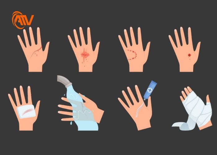 Kỹ năng sơ cứu vết thương hở