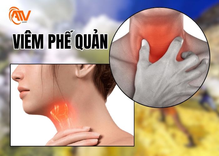 Viêm phế quản