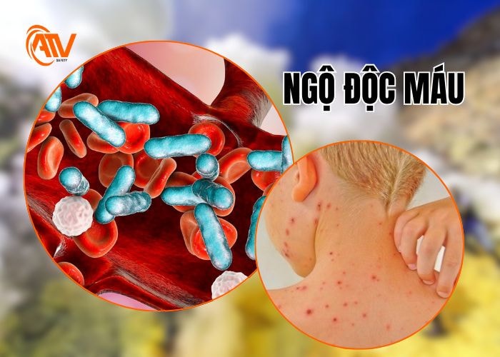 Ngộ độc lưu huỳnh gây ngộ độc máu