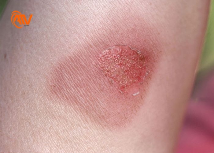 Bỏng nông ảnh hưởng đến lớp thượng bì