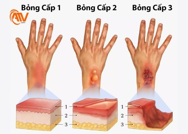 Bỏng sâu ảnh hưởng đến lớp da sâu hơn